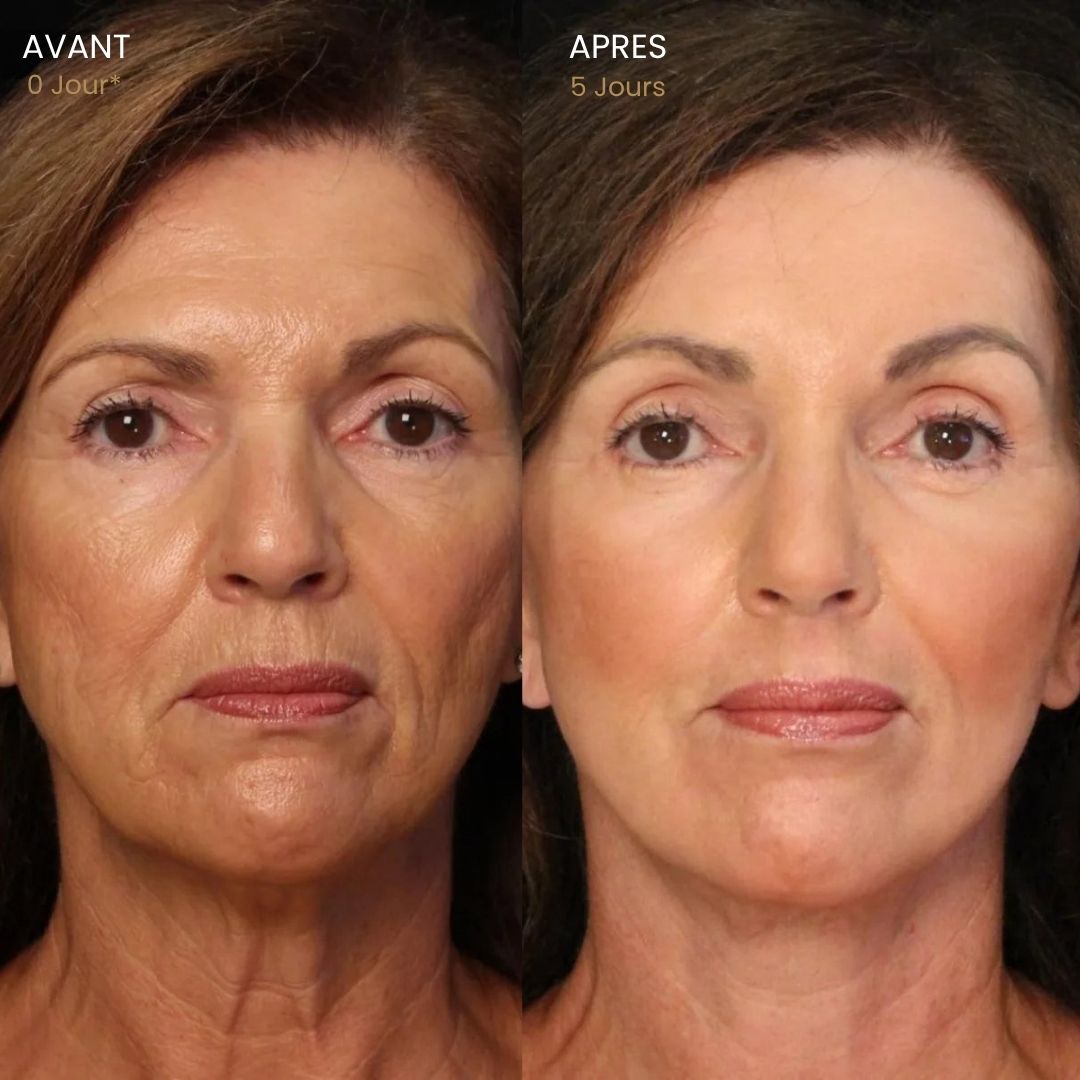 Brosse Lymphatique Visage